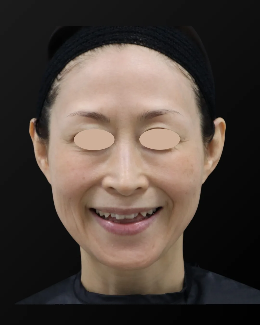50代女性｜笑顔｜治療前