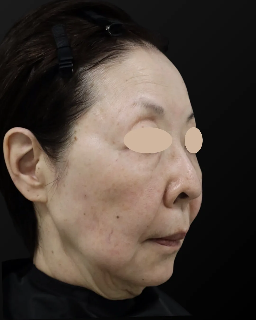 70代｜斜め｜治療後