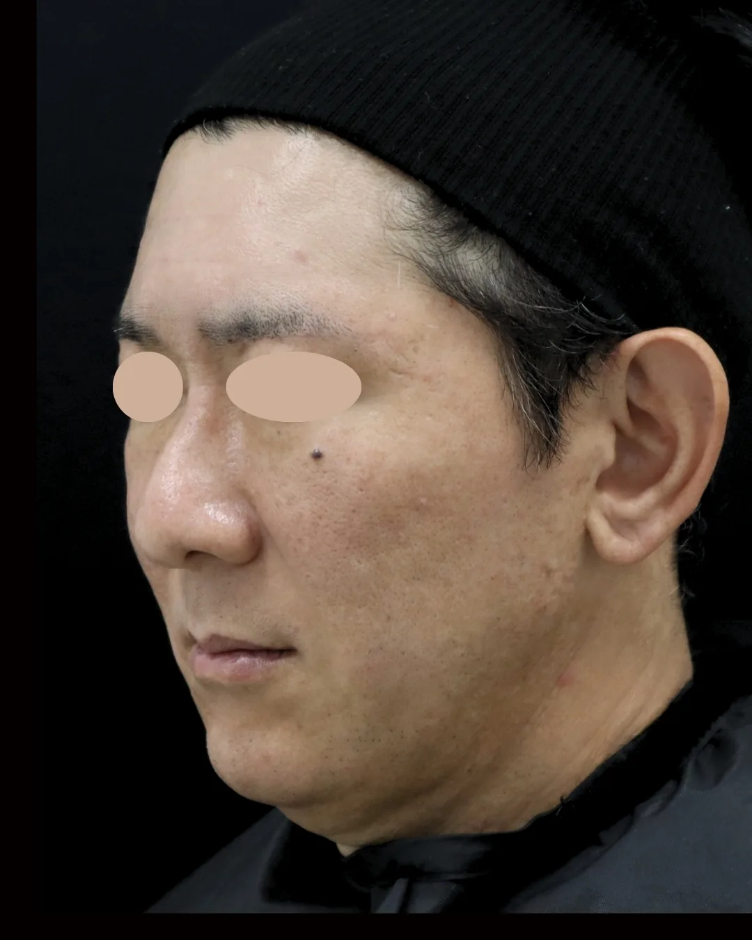 50代男性｜斜め｜治療後