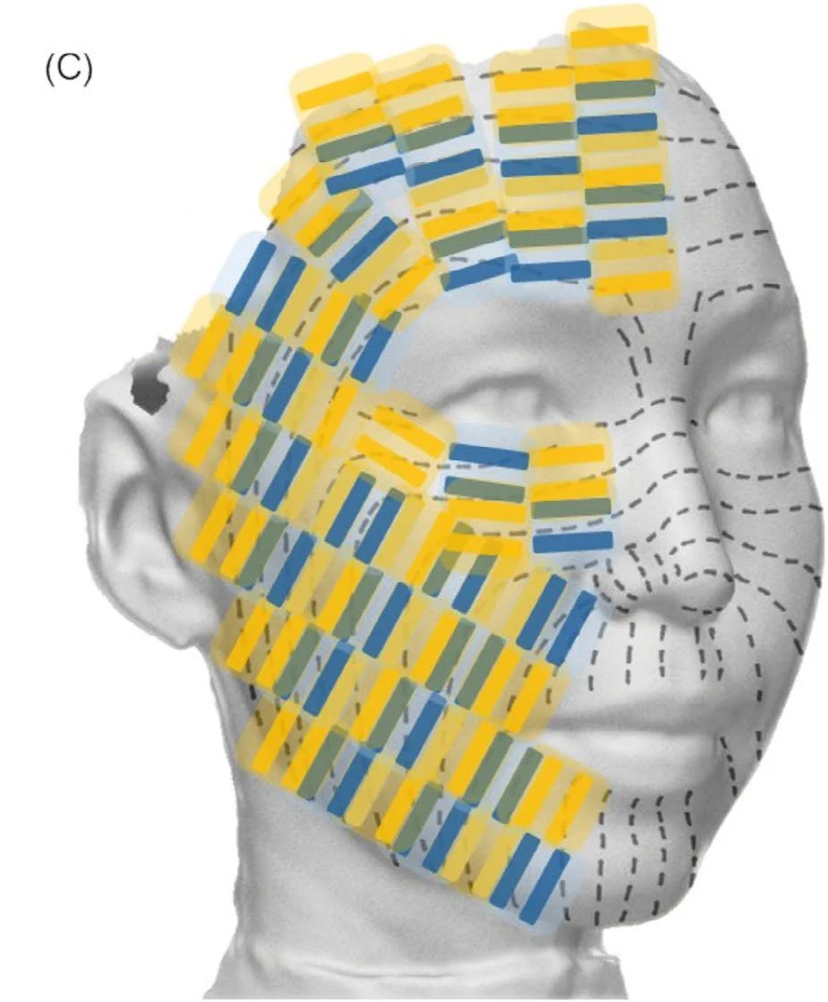 論文の図:顔の3D画像の上に、皮膚に沿った熱の帯を、しわの向きと直角になるように並べた照射の図