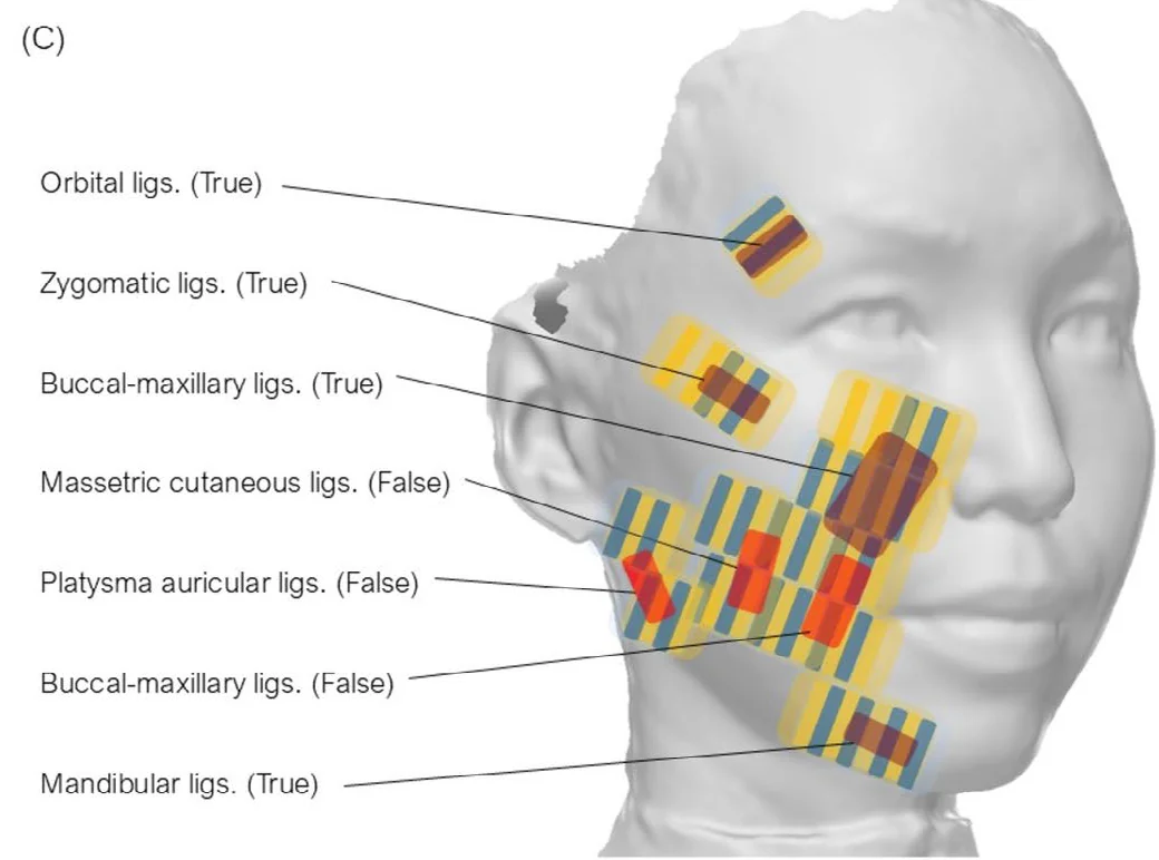 論文の図:顔の3D画像の上で、顔を支える支持靭帯の位置に深さ方向の熱を重ねた照射の図