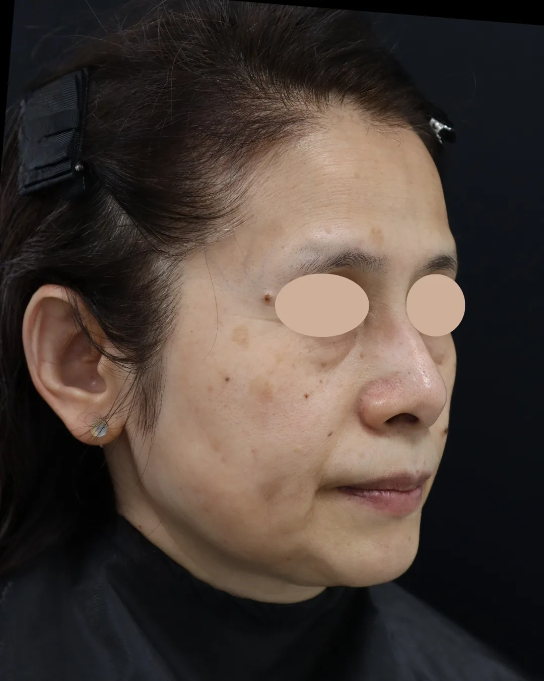 60代｜斜め｜治療前