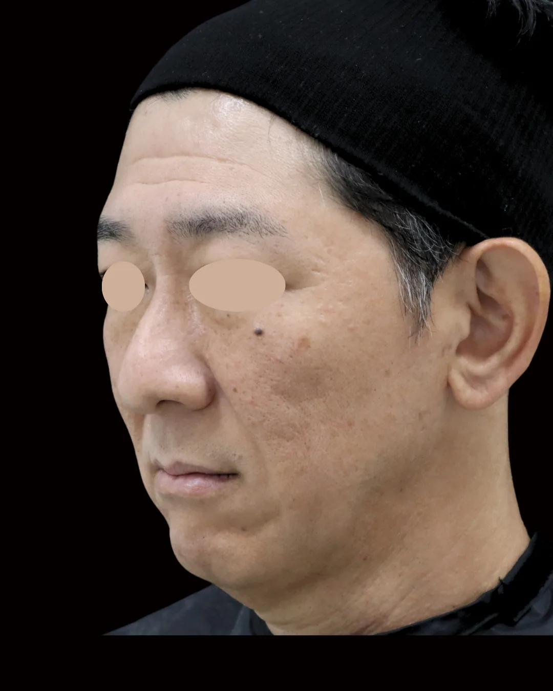 50代男性｜斜め｜治療前