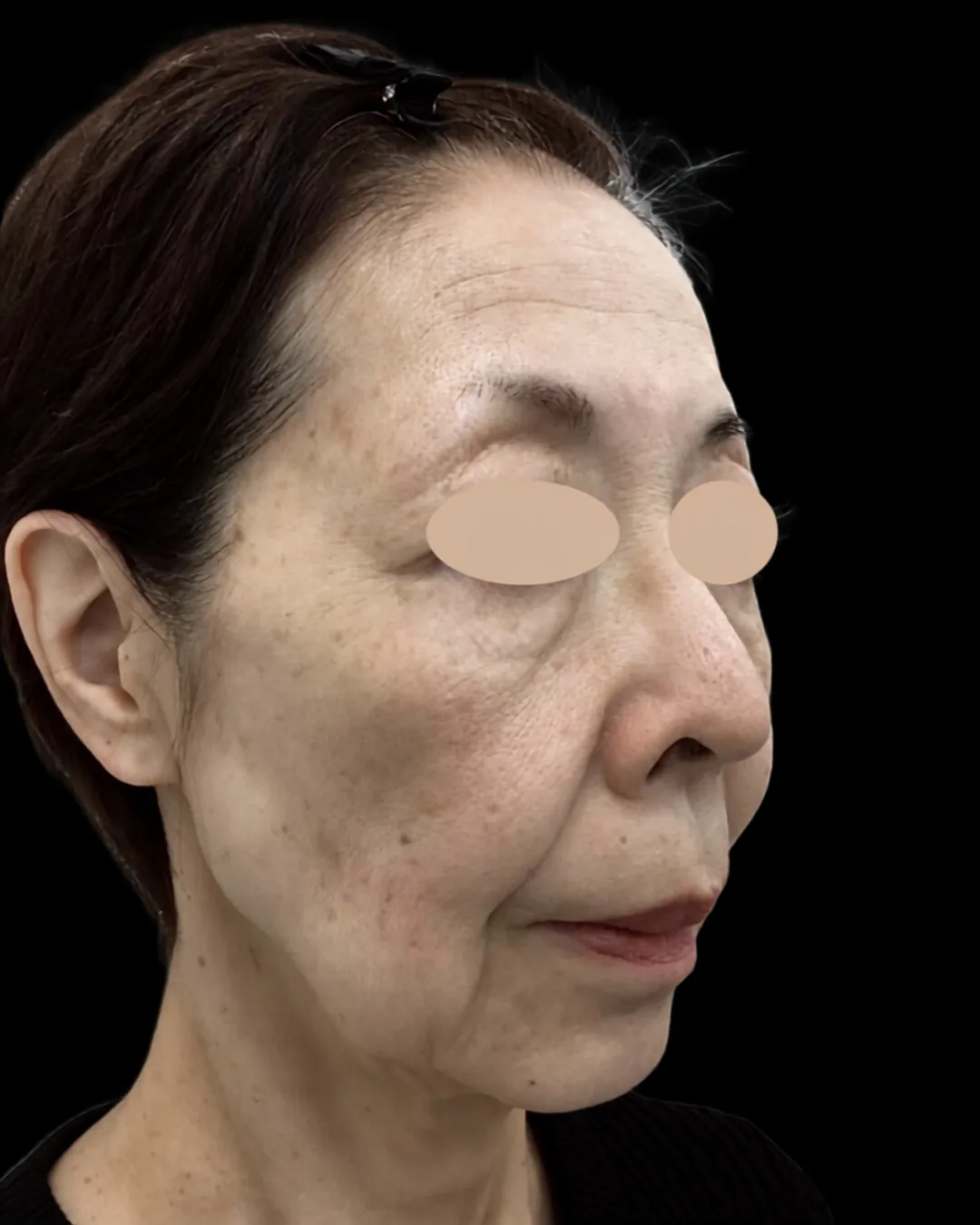 70代｜斜め｜治療前