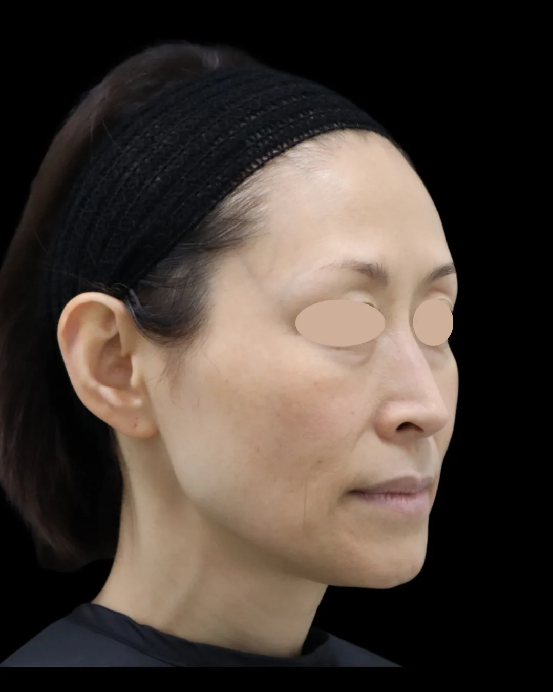 50代女性｜斜め｜治療前