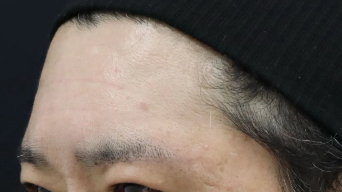 症例 11｜TYPE B 刻まれたしわ＋TYPE C くぼみ｜50代男性｜治療後