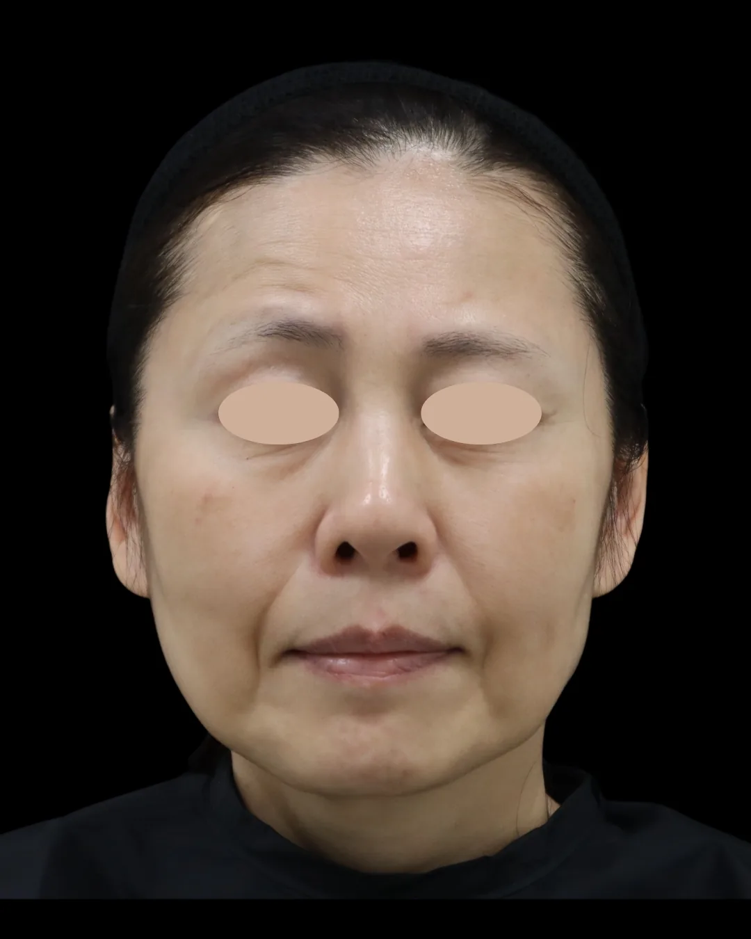 50代｜正面｜治療前