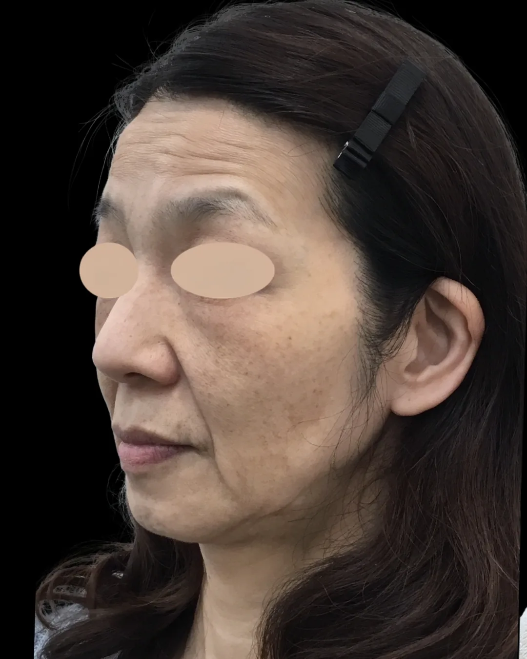 50代｜斜め｜治療前