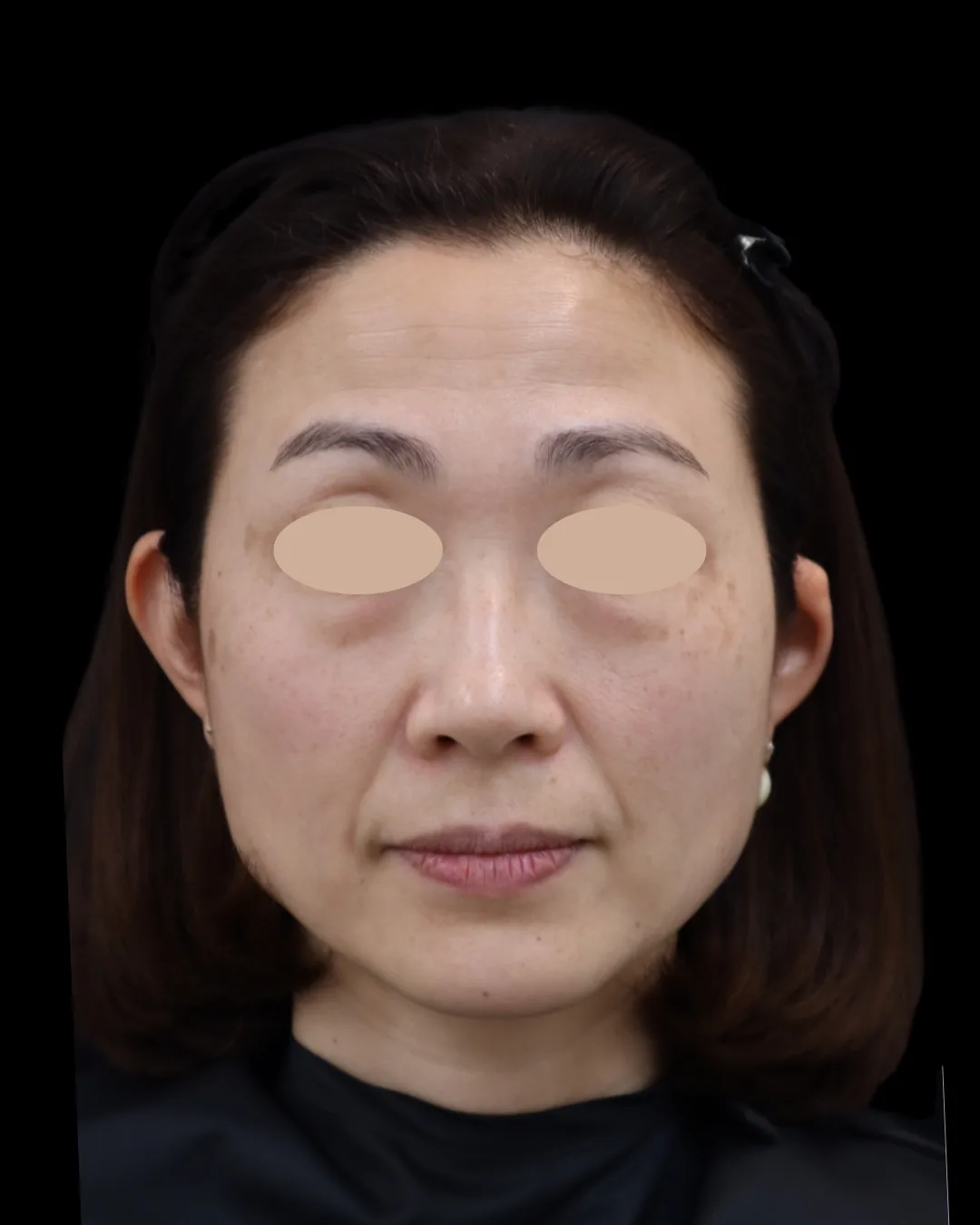 40代｜正面｜治療前
