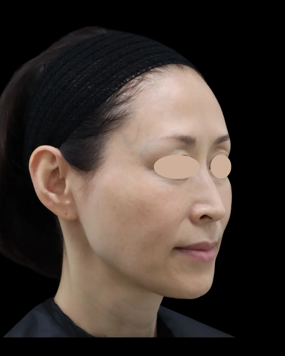 50代女性｜斜め｜治療後