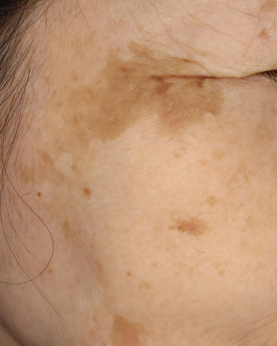 症例01（脂漏性角化症・日光性色素斑）の治療前