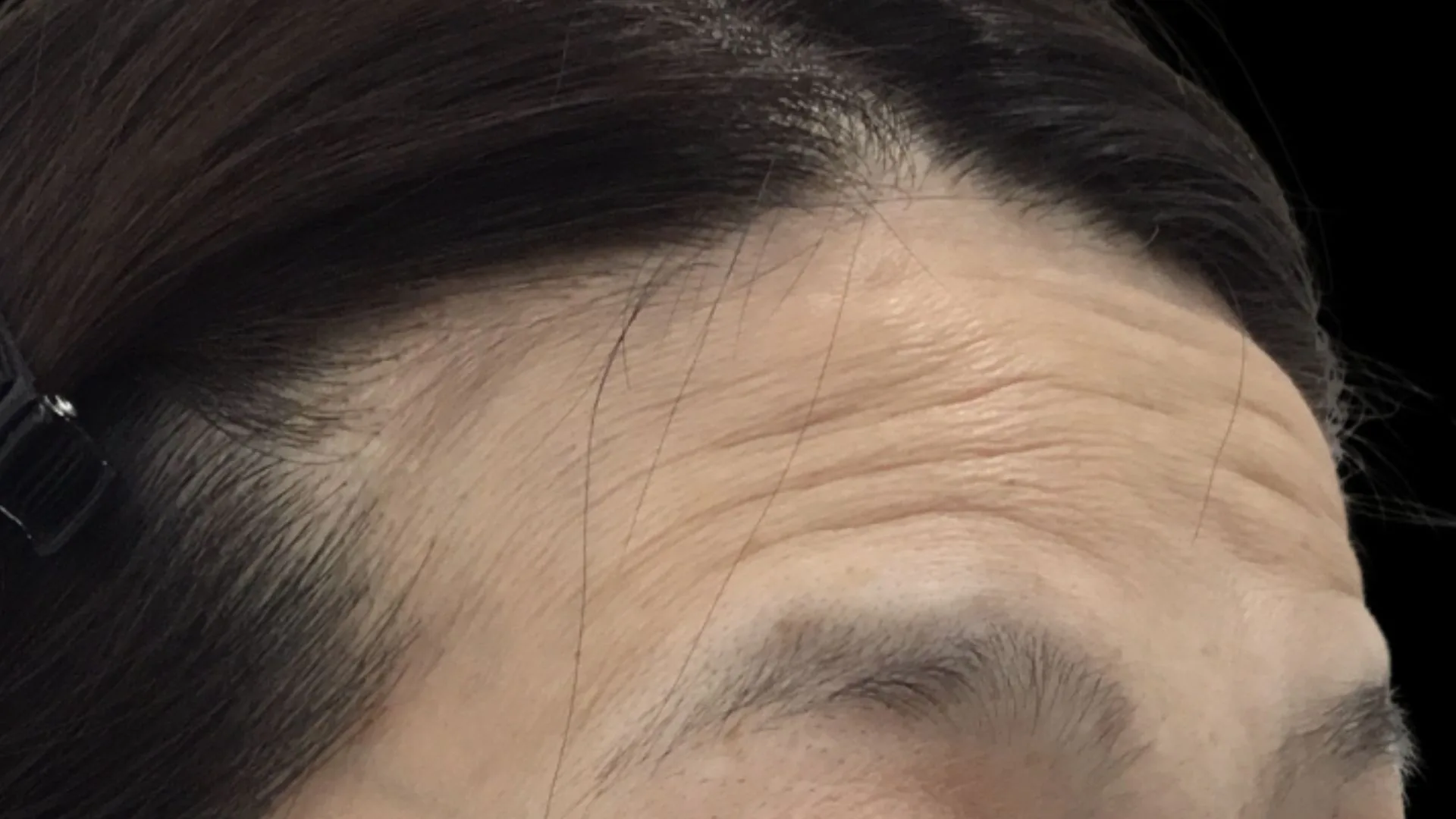 症例 07｜TYPE ＋ 混合｜50代女性｜治療前