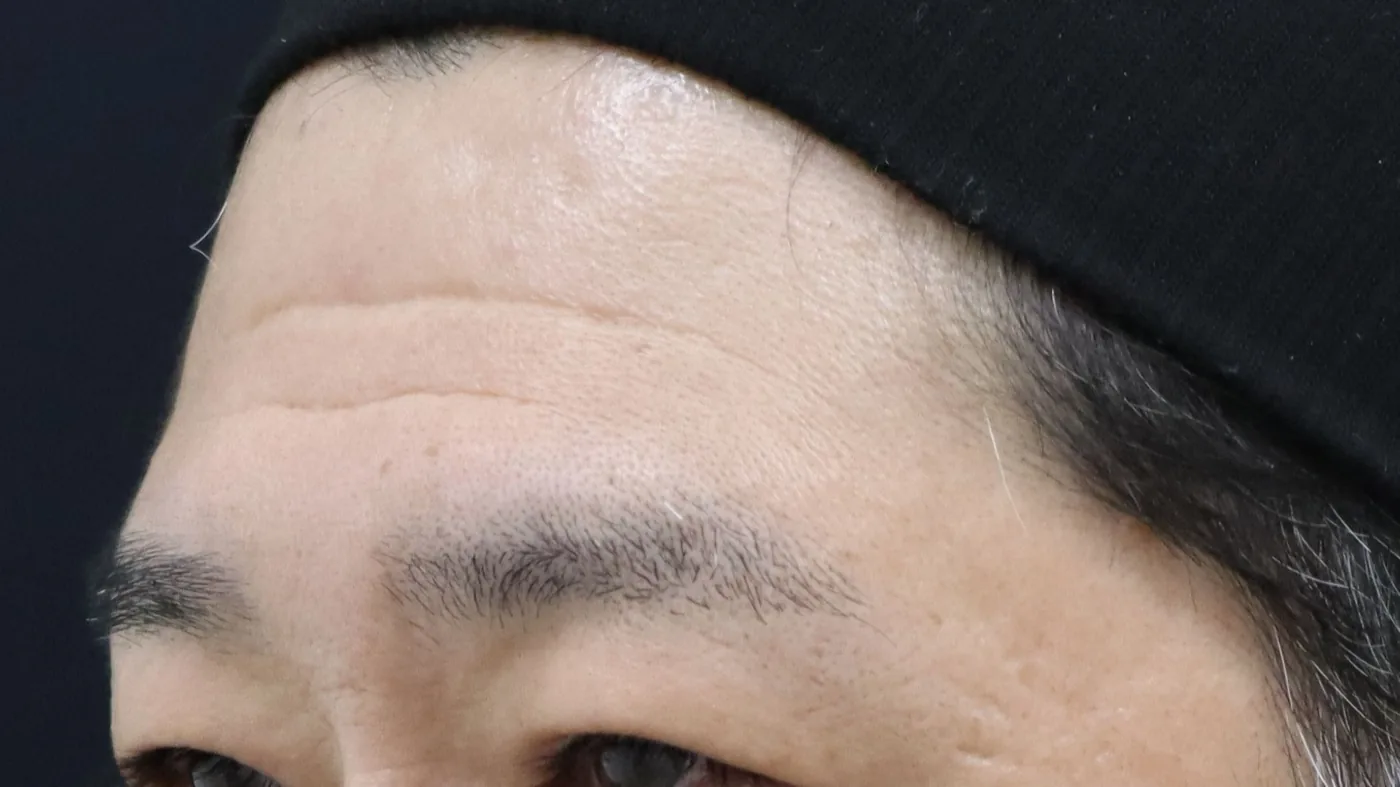 症例 11｜TYPE B 刻まれたしわ＋TYPE C くぼみ｜50代男性｜治療前