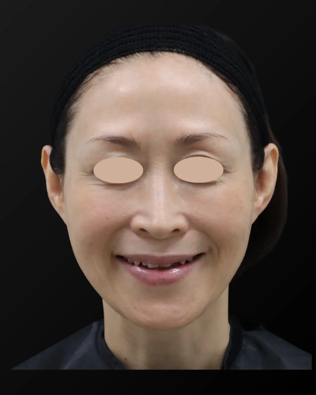 50代女性｜笑顔｜治療後