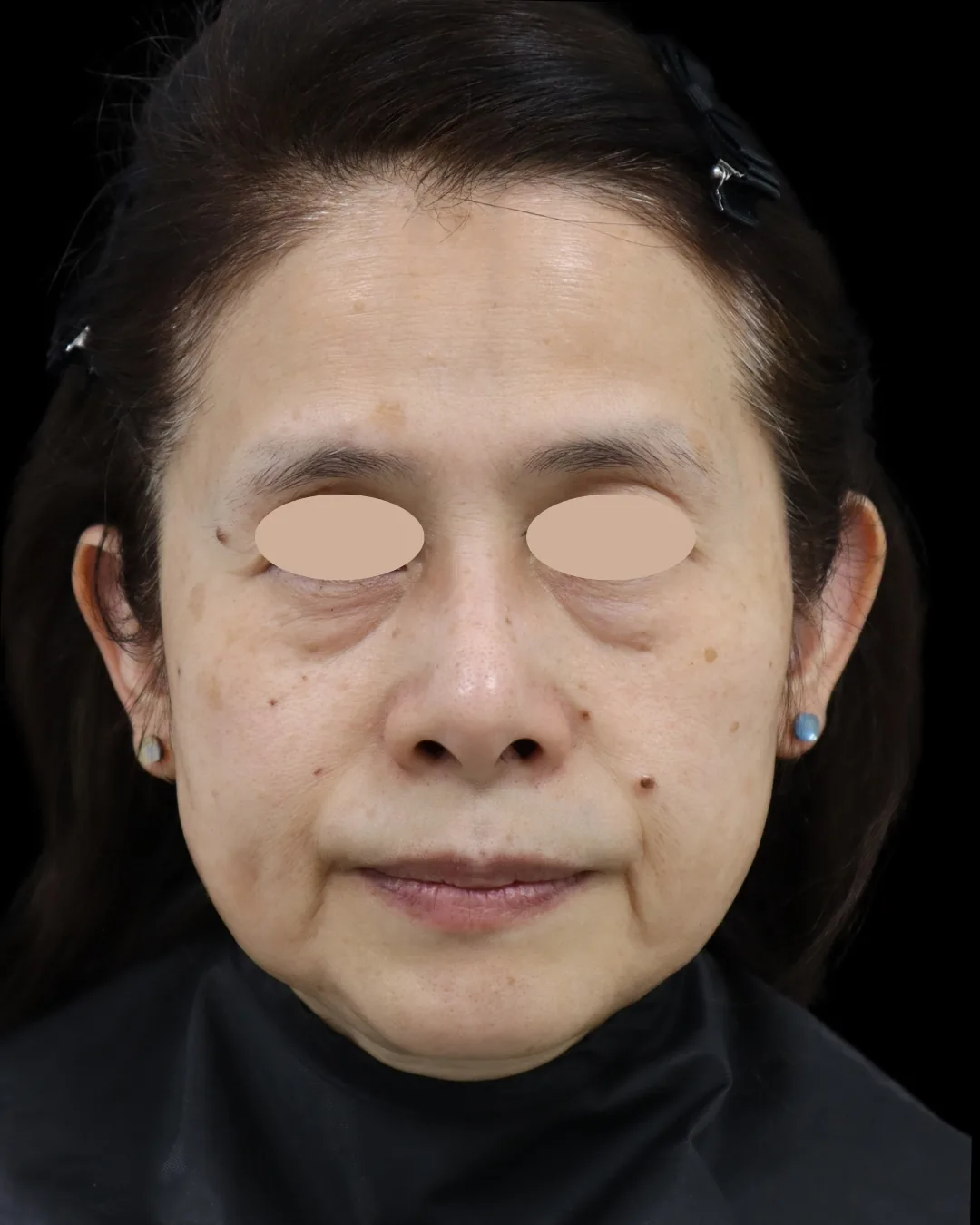 60代｜正面｜治療前